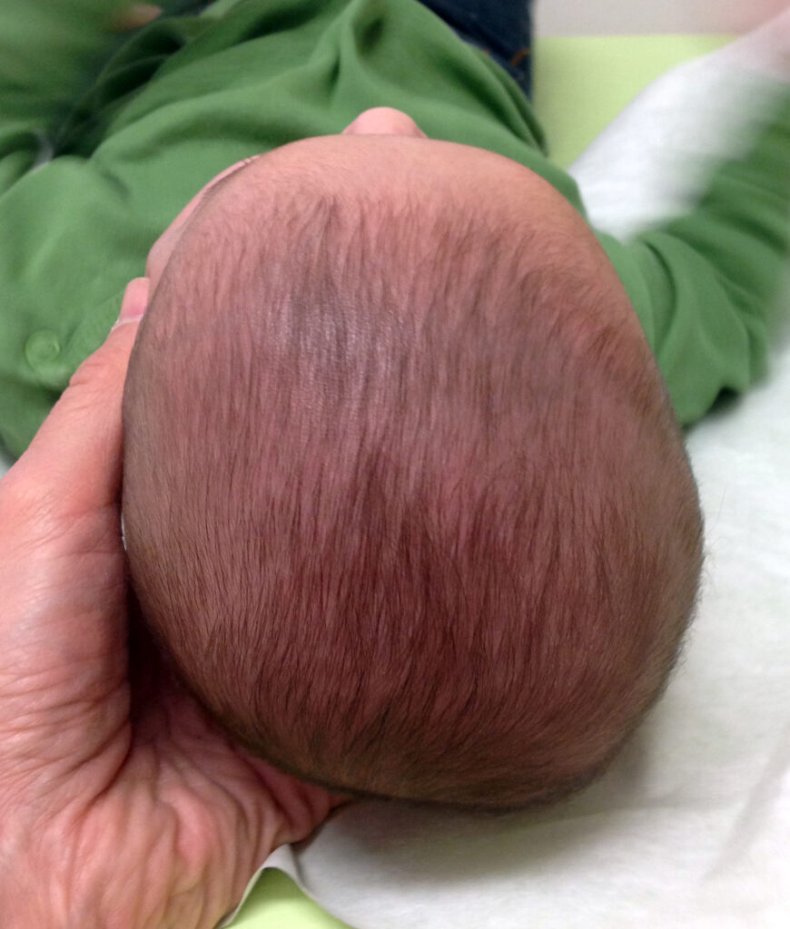 tête plate bébé plagiocéphalie positionnelle nourrisson Le Havre